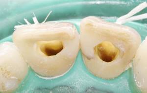 эндодонтическое отбеливание зуба что это такое
