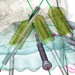 3D моделирование будущей имплантации зубов