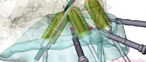 3D моделирование будущей имплантации зубов