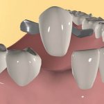 адгезивный зубной мост