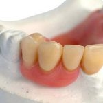 Акриловые протезы