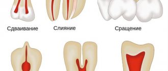 Аномалии развития зубов