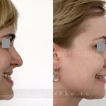 Аномалии верхней и нижней челюсти