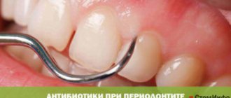 Antibiotics for periodontitis