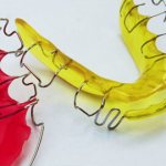 аппарат брюкля