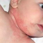 Atopic dermatitis in an infant