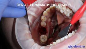 Атравматичное удаление зуба 3.6