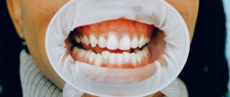 белые пятна на зубах причины