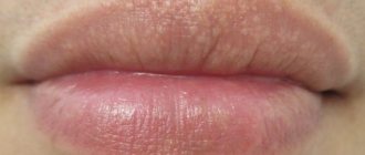White spots on the lips, small pimples. Causes of rash, treatment of Fordyce granules