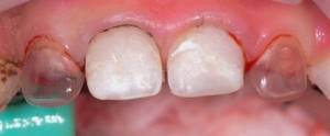 Безопасность использования протезов для молочных зубов