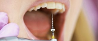 Болит депульпированный зуб - Стоматология Линия Улыбки