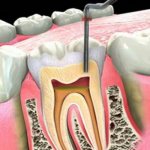 болит зуб под пломбой удаление нерва