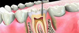 tooth hurts under filling nerve removal