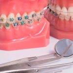 Брекет-системы