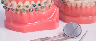 Брекет-системы