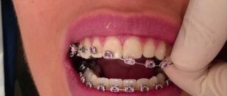 Брекеты - самые быстрые в игнотовлении. Стандартные брекет-системы изготавливаются под вас в течение 1-2 дней