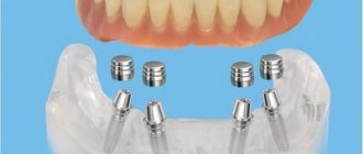 Clasp dentures patient reviews, dentist recommendations