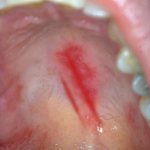 царапины на небе у ребенка фото