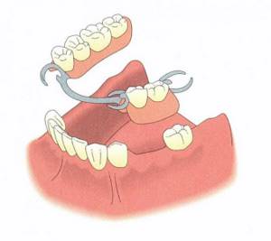 частичные зубные протезы