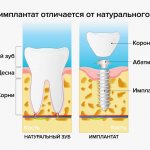 Чем имплант отличается от натурального зуба в картинках
