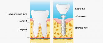 Чем имплант отличается от натурального зуба в картинках