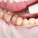 Чистка зубов скайлером