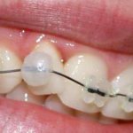 Что собой представляет воск для брекетов