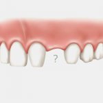что ставят вместо удаленного зуба