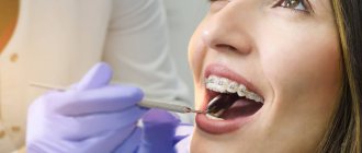 Что такое сепарация зубов в стоматологии