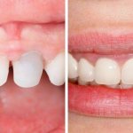 Что такое стоматологический цирконий?