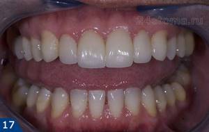Что такое стоматологический цирконий?