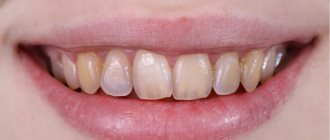 Деминерализация зубов - признаки и причины.