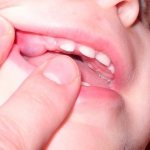 Десна при прорезывании зубов