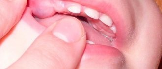 Gums during teething