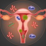 дисбиоз влагалища