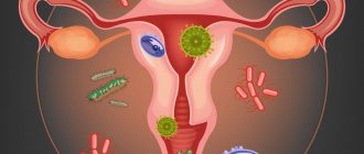 дисбиоз влагалища