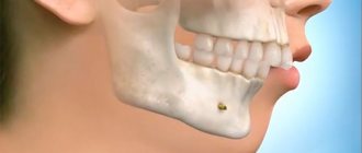 Distal bite