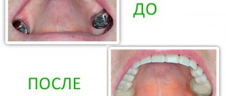 what is a removable sandwich denture for?