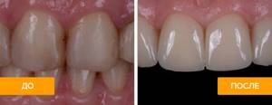 До и после установки коронок на передние зубы