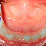 Дырки в молочных зубах в 3 года