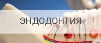 эндодонтия в стоматологии