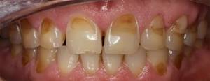 эррозия эмали зубов фото