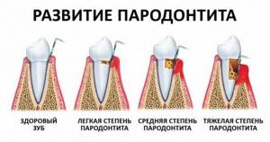 Если использовать лечебныепасты и гели, то к стоматологуобращаться не нужно.