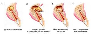 этапы цистэктомии гранулемы зуба