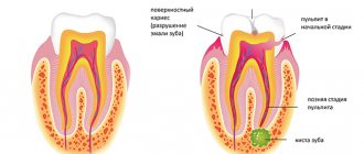 Этапы формирования кисты зуба