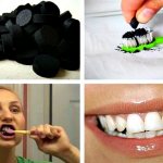 Stages of teeth whitening