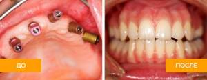 Фото до и после имплантации и протезировапния зубов