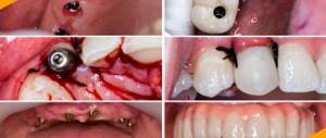 Фото до и после имплантации зубов в боковом отделе жевательных зубов, в области передних зубов и при полной адентии