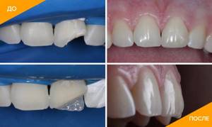 Фото до и после лечения перелома зуба