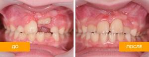 Фото до и после лечения при вколоченном вывихе зуба